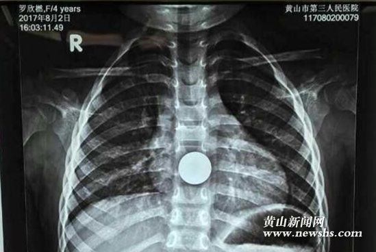 三岁幼童吞食硬币 医生妙手9分钟取出 三岁幼童吞食硬币 医生妙手9分钟取出